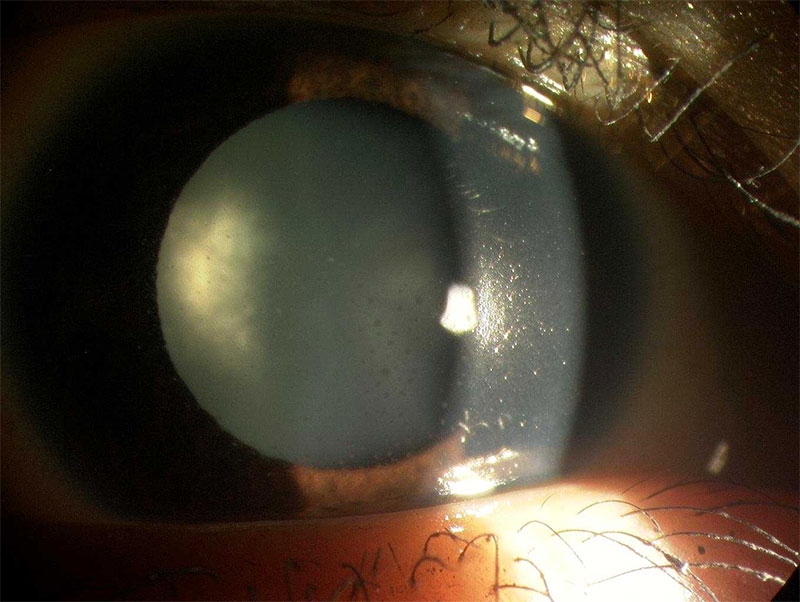 Cataract (posterior subcapsular type) in a patient with uveitis (as seen on specialized microscope to examine the eye).