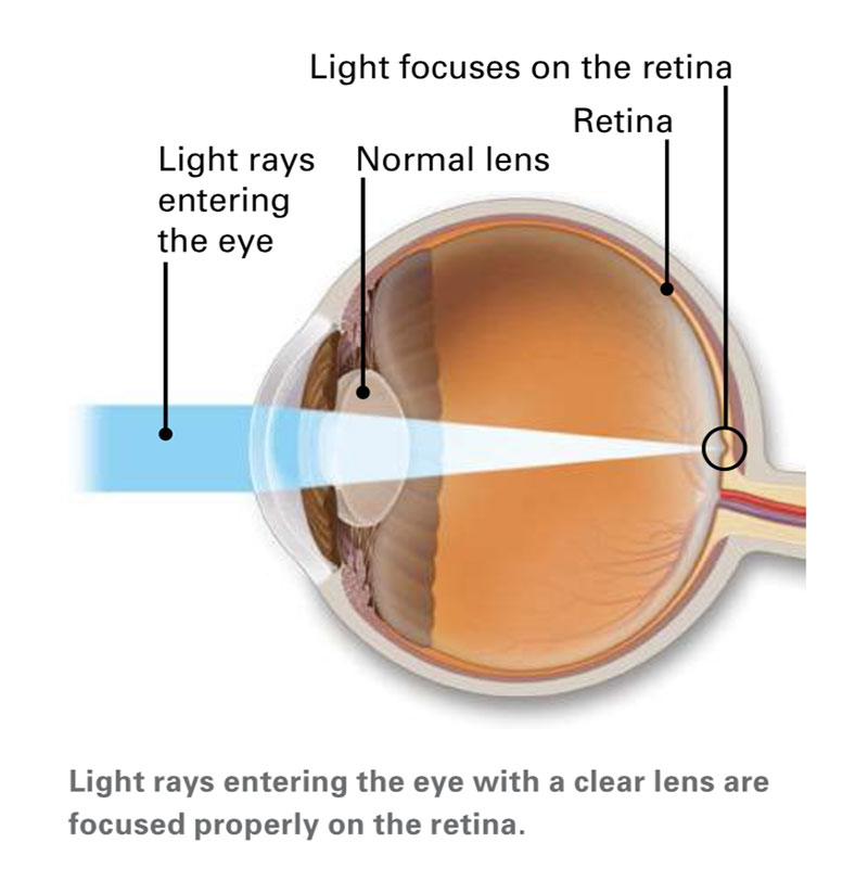 Light rays entering the eye with a clear lens are focused properly on the retina.