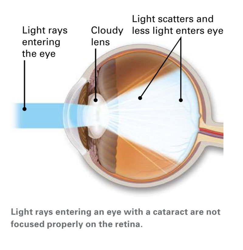 Light rays entering an eye with a cataract are not focused properly on the retina.