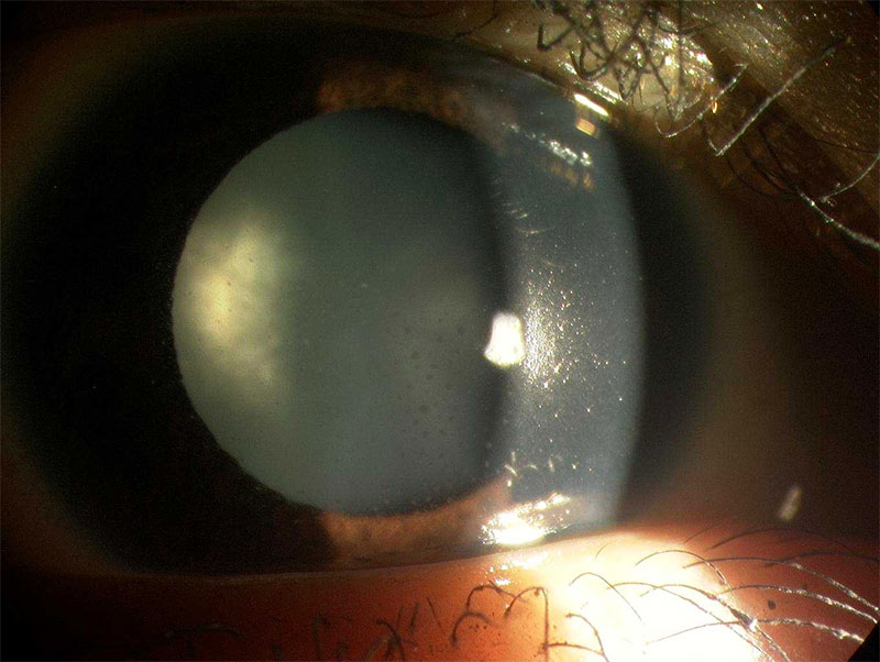 Cataract (posterior subcapsular type) in a patient with uveitis (as seen on specialized microscope to examine the eye).