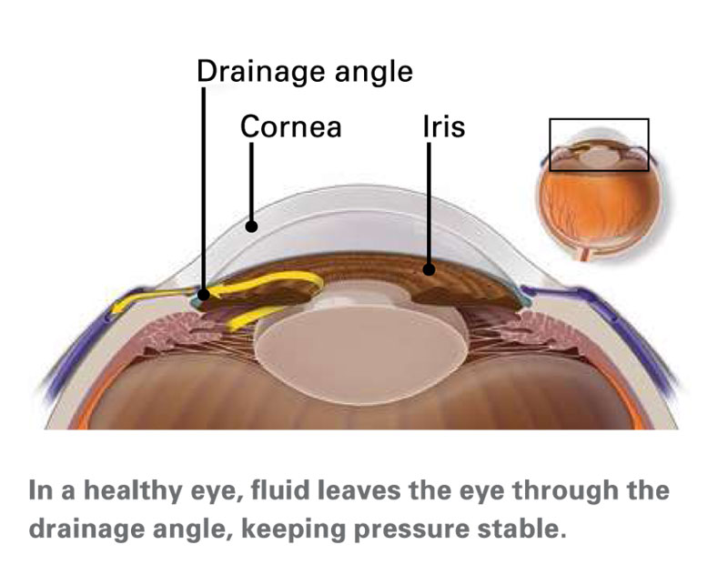 In a healthy eye, fluid leaves the eye through the draining angle, keeping pressure stable.
