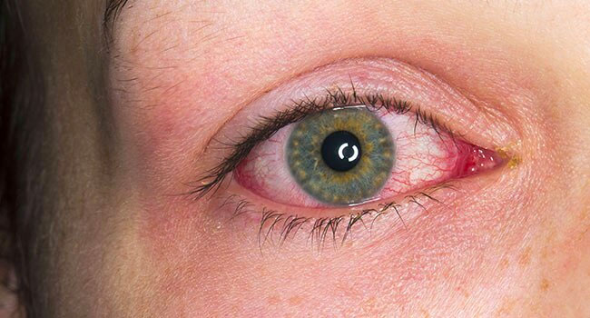 Patient with uveitis