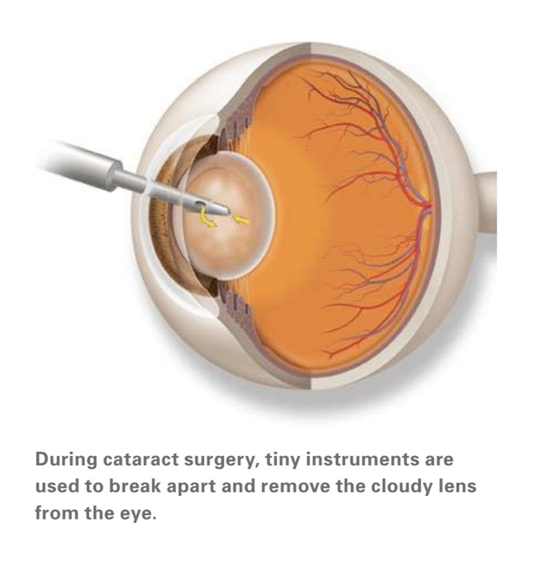 During cataract surgery, tiny instruments are used to break apart and remove the cloudy lens from the eye.