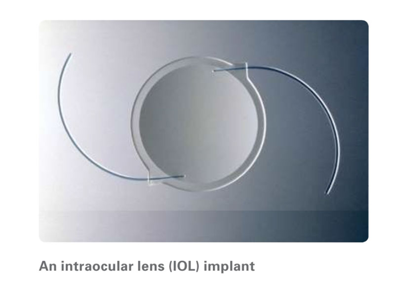 An intraocular lens (IOL) implant