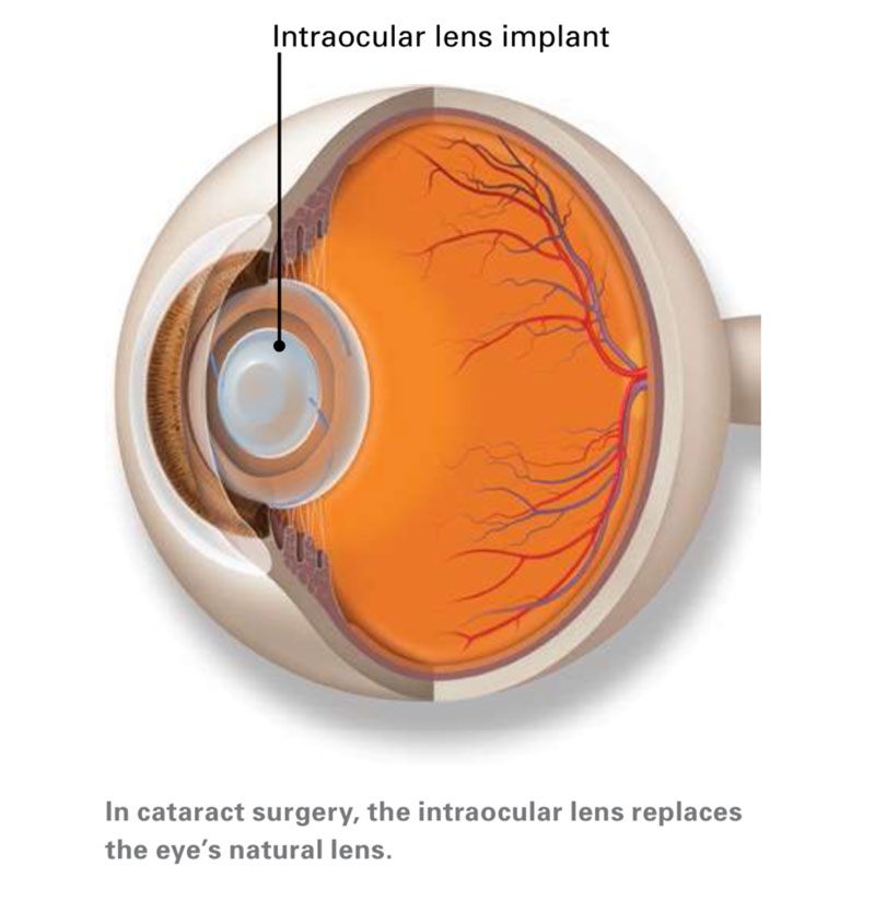 In cataract surgery, the intraocular lens replaces the eye's natural lens.