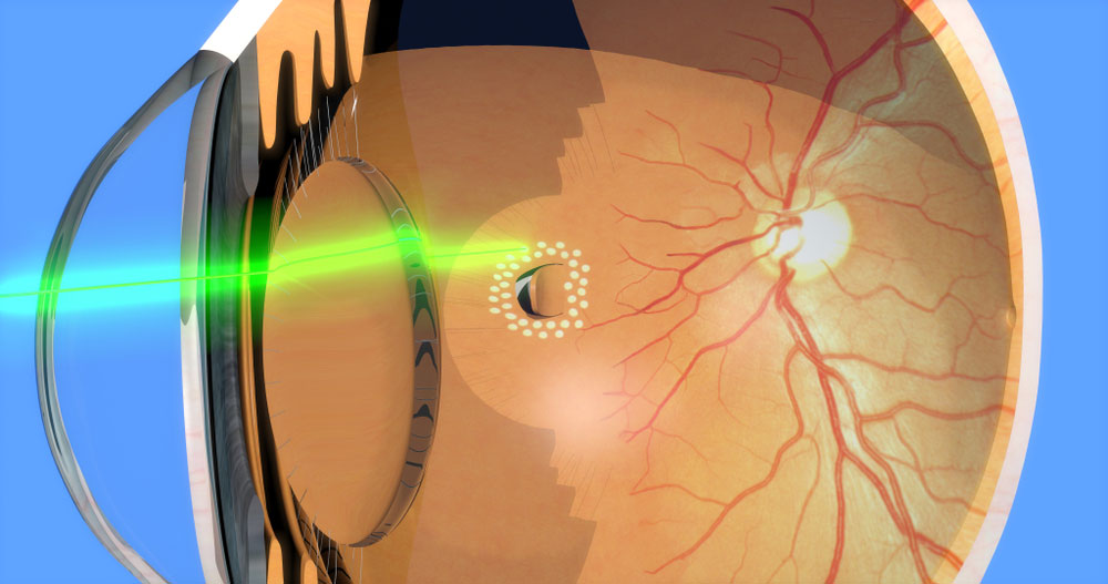 Laser photocoagulation around retinal tear