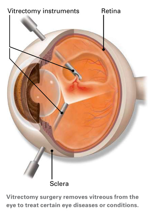 Vitrectomy surgery removes vitreous from the eye