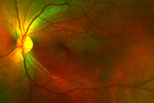 Retinal Laser & Diabetic Retinopathy